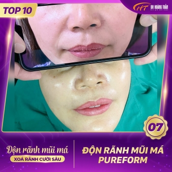 ĐỘN RÃNH MŨI MÁ